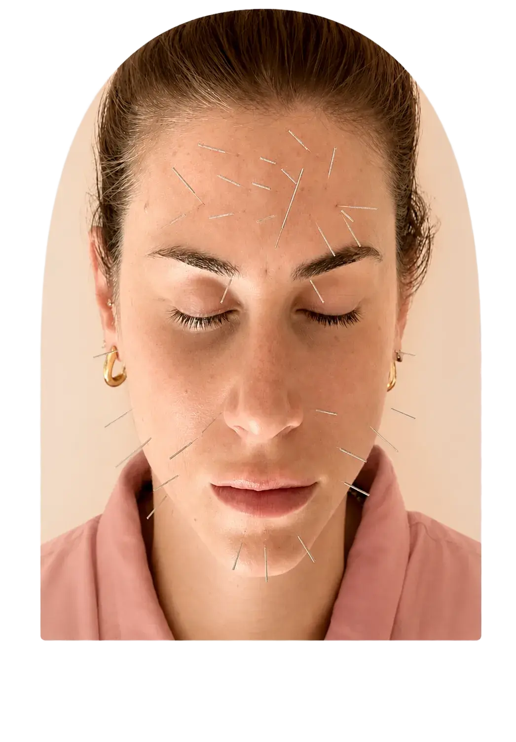 Acupuntura estética integrativa — ilustración con arco